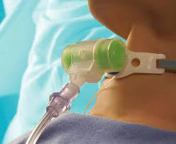 Intersurgical Hydro-Trach T Mk Ii Hme Thermovent