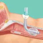 Shiley Xlt Tracheostomy Tubes