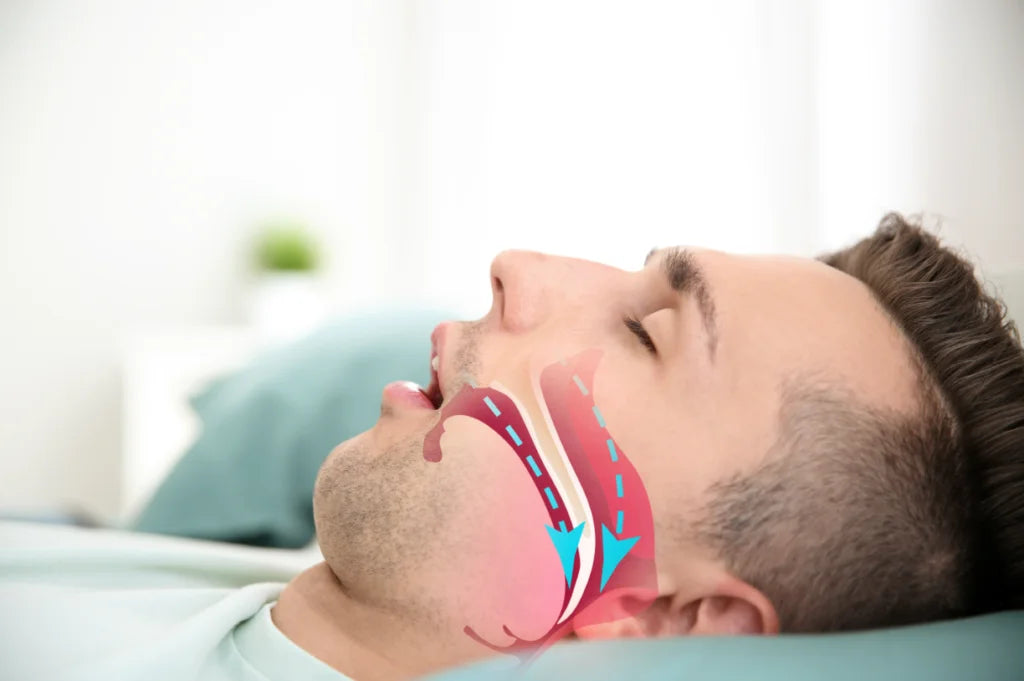 Understanding-Obstructive-Sleep-Apnea-updated-2024 